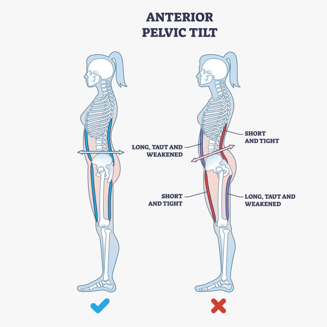 A colorful medical illustration of an Anterior Pelvic Tilt in a female patient.