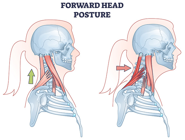 A colorful medical illustration of the cervical muscles displaying a Forward Head Posture.