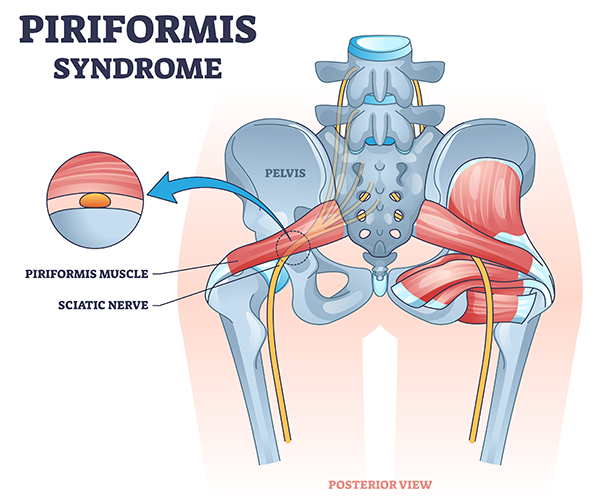 A colorful medical illustration with the piriformis muscle and sciatic nerve impingement.